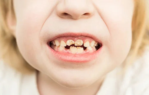 Young child showing tooth decay | brush baby toothbrushes and infant toothpaste